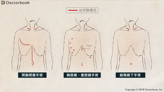 食道がんの手術……開胸、胸腔鏡、縦隔鏡という選択肢 | Doctorbook 食道がんの手術……開胸、胸腔鏡、縦隔鏡という選択肢 | Doctorbook
