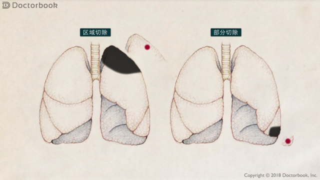 肺がんの縮小手術