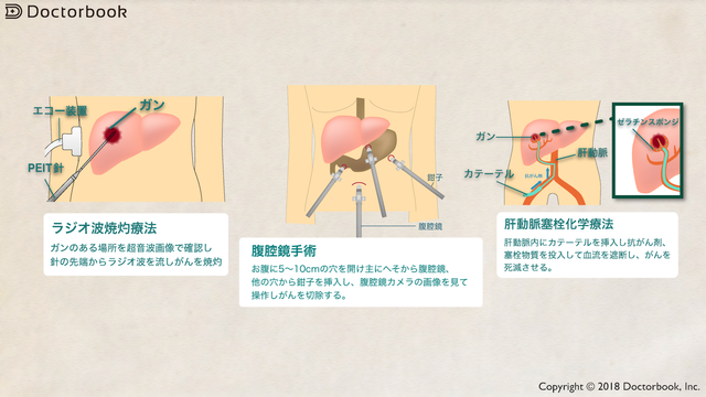 医師出演 肝細胞がんの治療法とは 多彩な治療法からどのように選ぶのか Doctorbook 医師出演 肝細胞がんの治療法とは 多彩な治療法からどのように選ぶのか Doctorbook