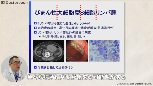 医師出演 びまん性大細胞型b細胞リンパ腫の治療法 検査から投薬に至るまで Doctorbook