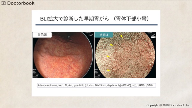 医師出演】NBI・BLIによる胃がんの拡大内視鏡診断とは？ | Doctorbook