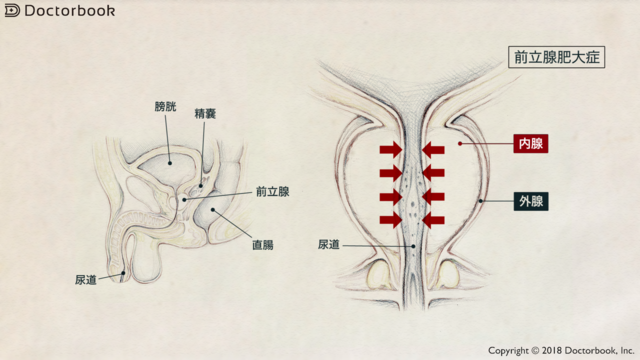 前立腺肥大症