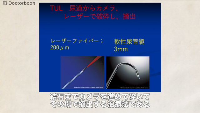 医師出演】尿路結石症の治療法:薬を飲んで治る?手術が必要 医師出演】尿路結石症の治療法:薬を飲んで治る?手術が必要