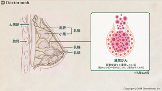 乳がんの概要