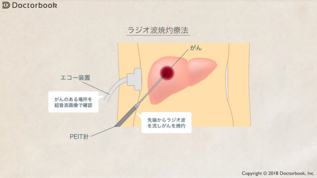 動画でわかる 肝がん の病気 症状 治療方法の動画 医療情報 Doctorbook 動画でわかる 肝がん の病気 症状 治療方法の動画 医療情報 Doctorbook