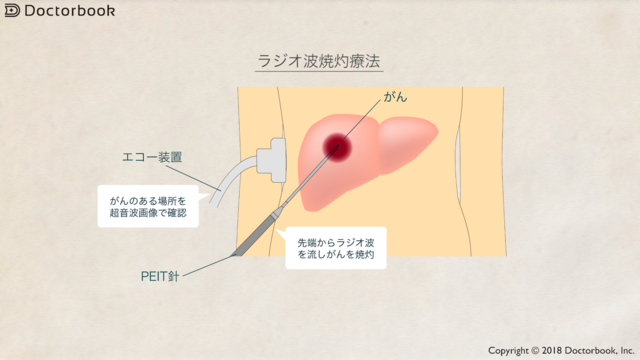 肝がんのラジオ波焼灼療法