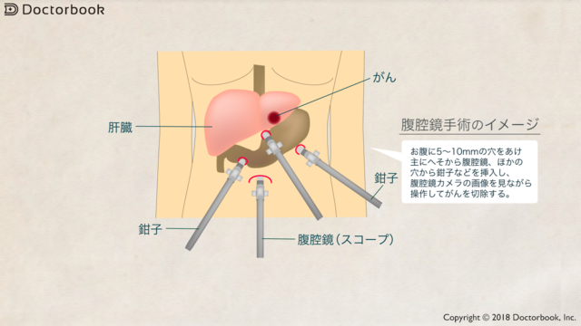 肝がんの腹腔鏡手術のイメージ