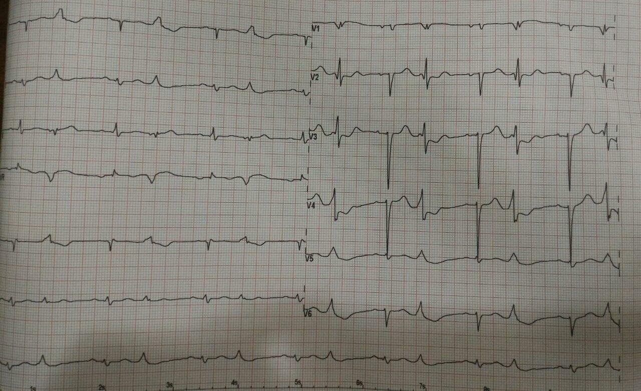 EKG PVC BIGEMINI 1 stripalllossy1ssl1