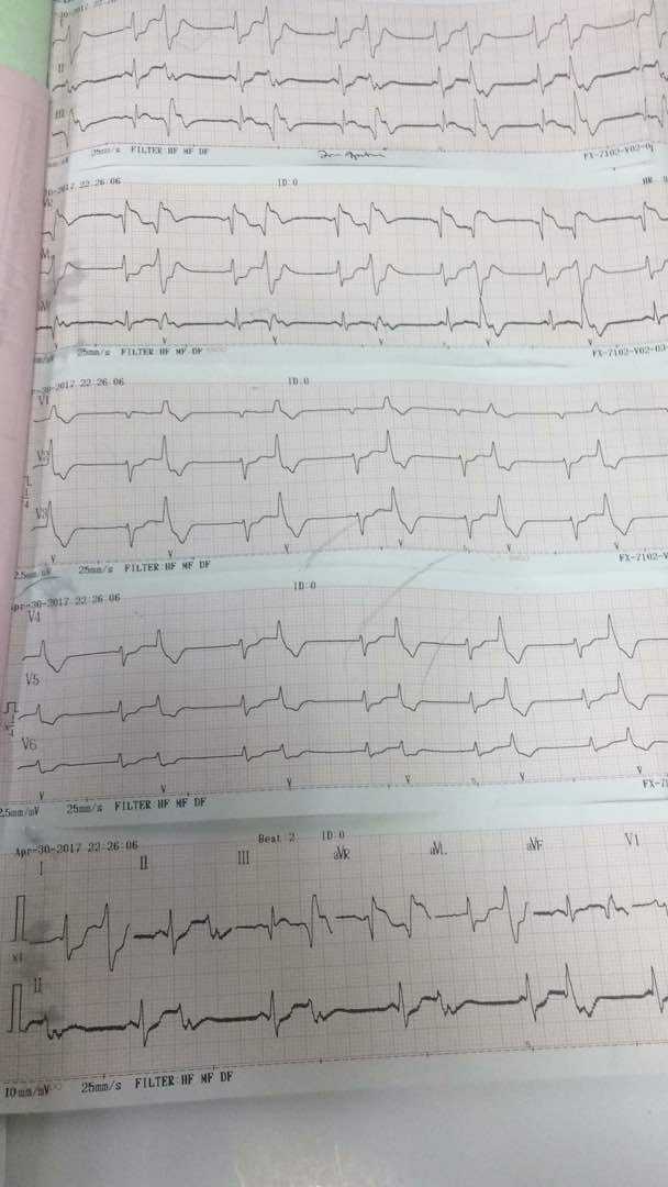 EKG STEMI Main Left Artery stripalllossy1ssl1