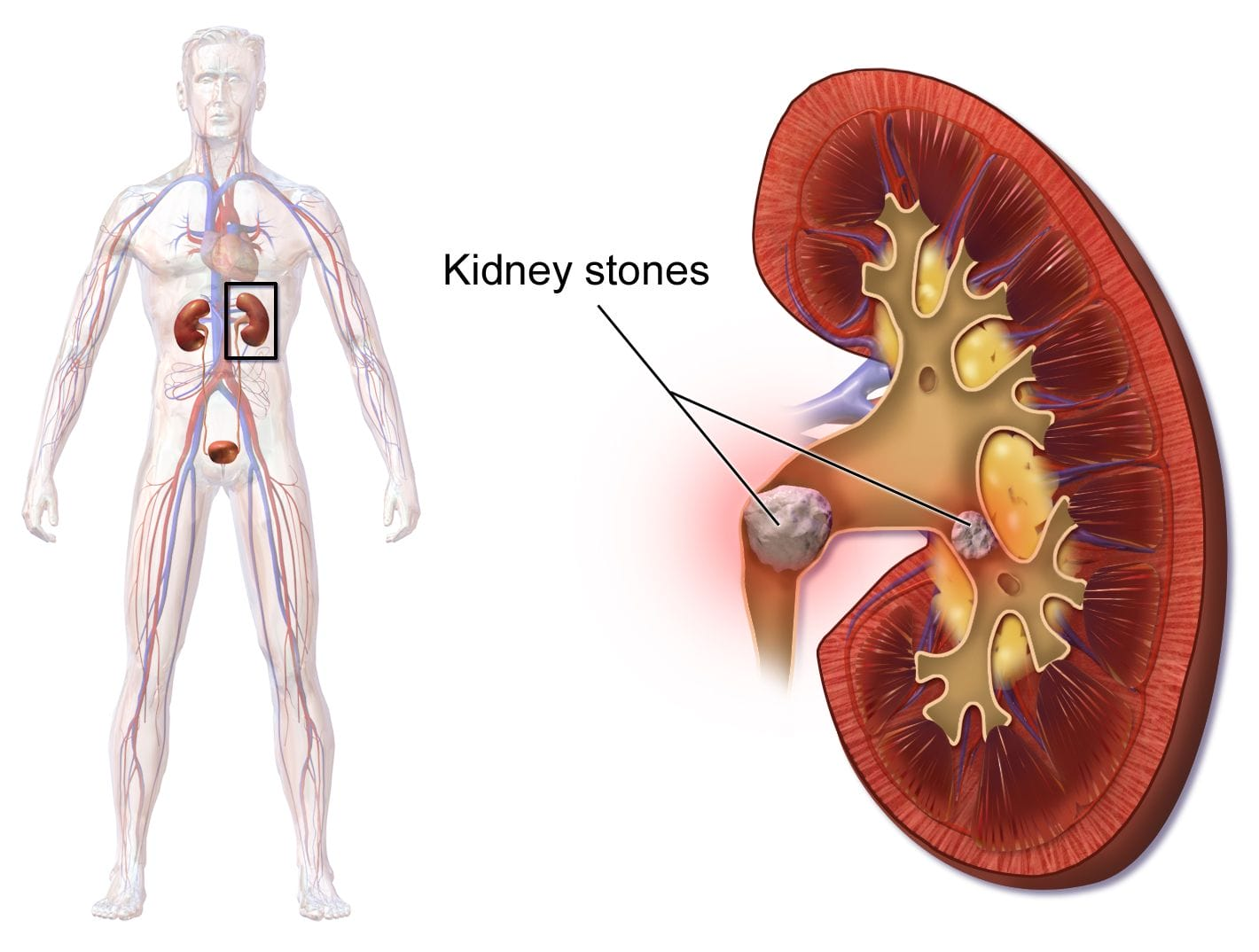 Kidney Stones stripalllossy1ssl1