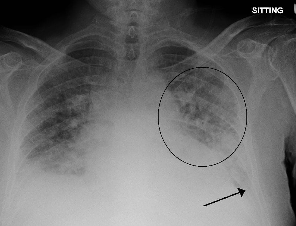 Pulmonary Edema stripalllossy1ssl1