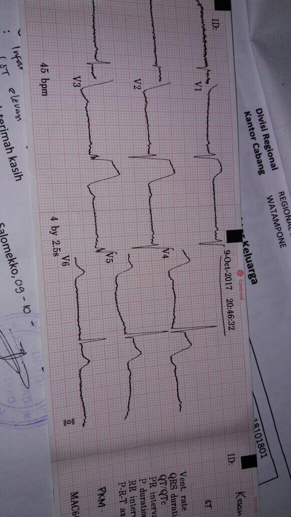 STEMI Anteroseptal 005 stripalllossy1ssl1