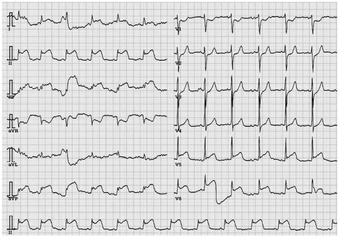 Stemi SAH stripalllossy1ssl1