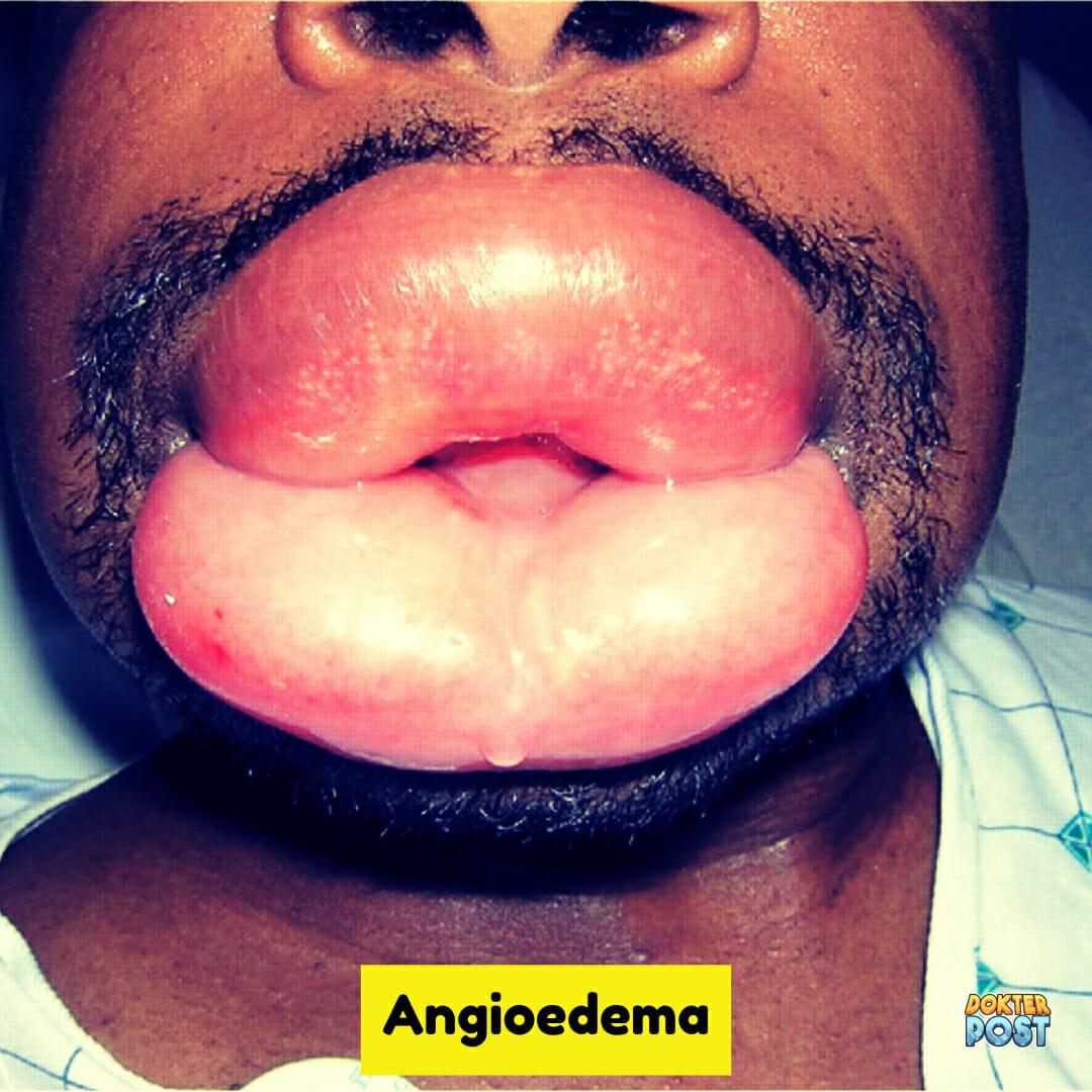 Angioedema stripalllossy1ssl1