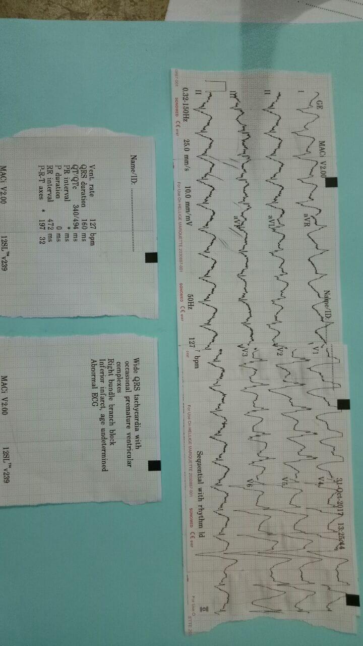 Ecg hiperkalemia impending VT stripalllossy1ssl1