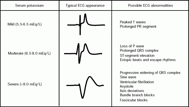 Ecg hyperkalema stripalllossy1ssl1