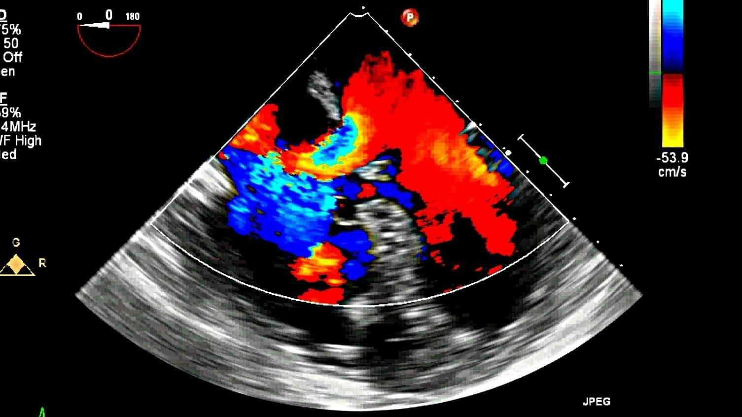 Echocardiography stripalllossy1ssl1