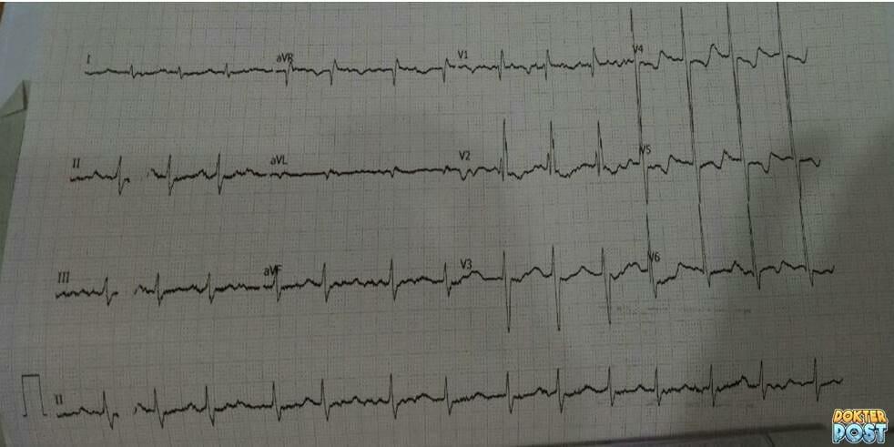 Hipokalemia ekg IGD stripalllossy1ssl1