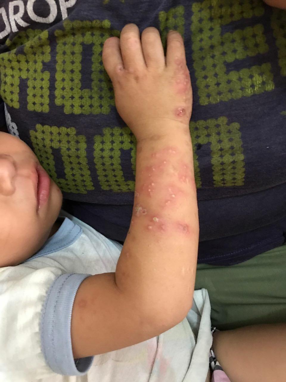 Impetigo krustosa infeksi sekunder stripalllossy1ssl1