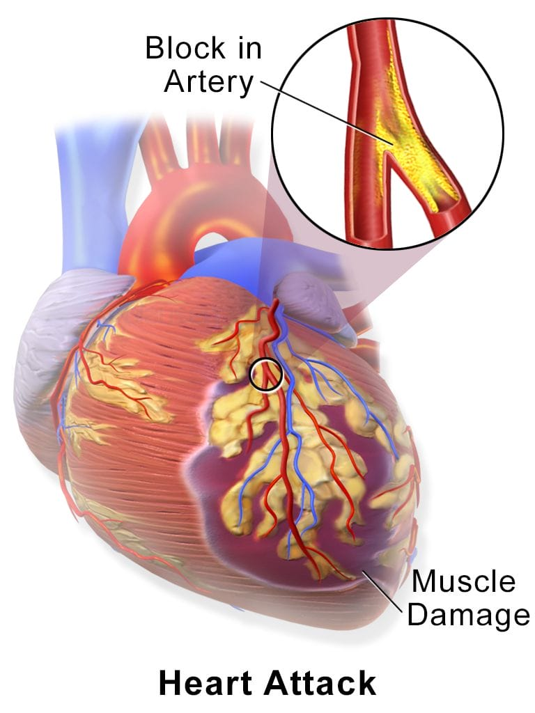 Infark myocard acute stripalllossy1ssl1