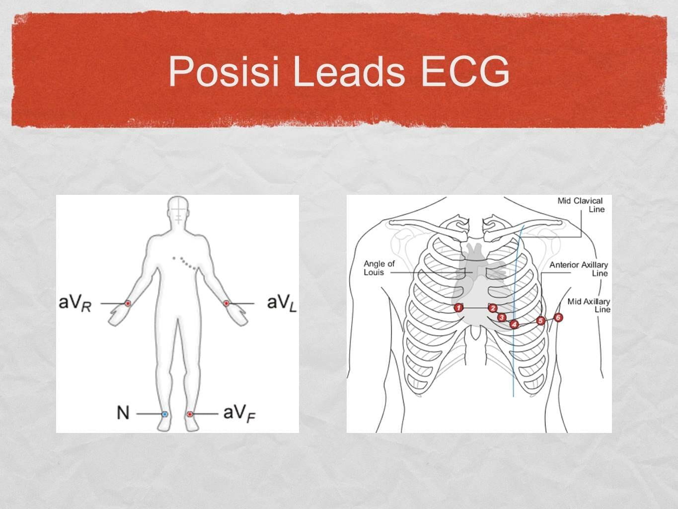 Posisi lead ecg stripalllossy1ssl1