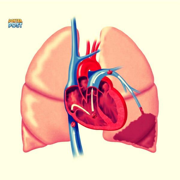 Pulmonary embolism stripalllossy1ssl1