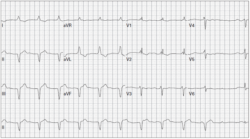 Sinus 65 bpm stripalllossy1ssl1