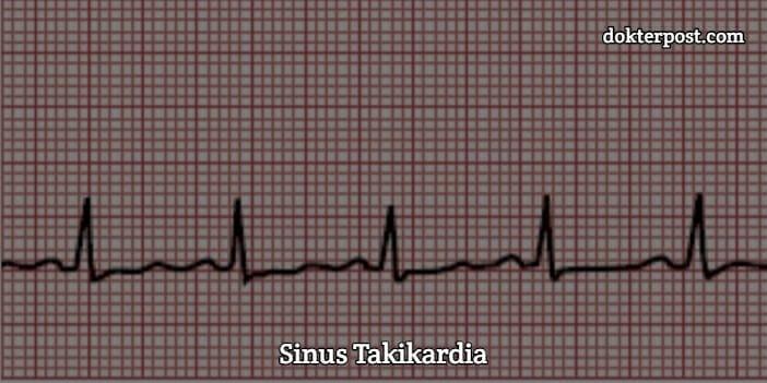 Sinus takikardi stripalllossy1ssl1