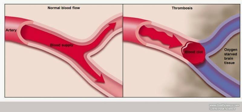 Thrombosis stripalllossy1ssl1