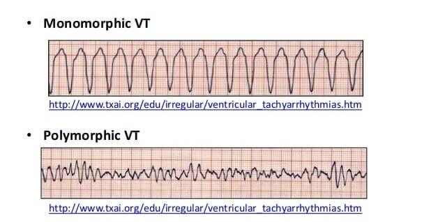 Ventricuar tachycardia stripalllossy1ssl1