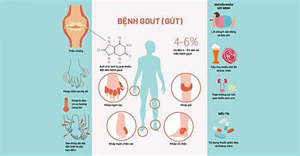 Bệnh gút: Nguyên nhân và cách phòng ngừa