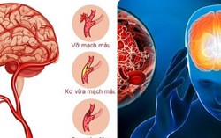 7 dấu hiệu cảnh báo cơn đột quỵ sắp xảy ra