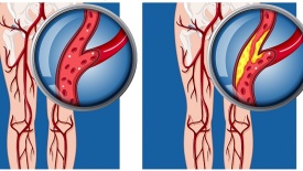 Biến chứng của bệnh lý động mạch