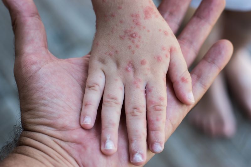 Giám sát chặt bệnh sởi, rubella