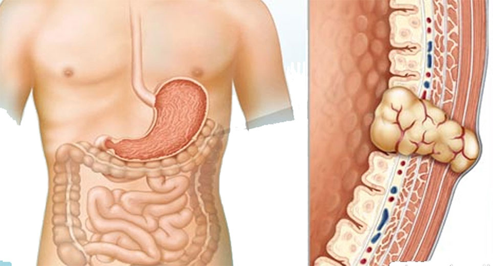 Bác sĩ trả lời: Đã cắt u mô đệm đường tiêu hóa, liệu còn tái phát nữa không?