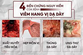 Viêm hang vị dạ dày do vi khuẩn HP có thể điều trị dứt điểm không?