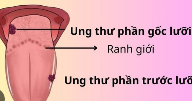 Người bệnh ung thư lưỡi nên tập luyện như thế nào?