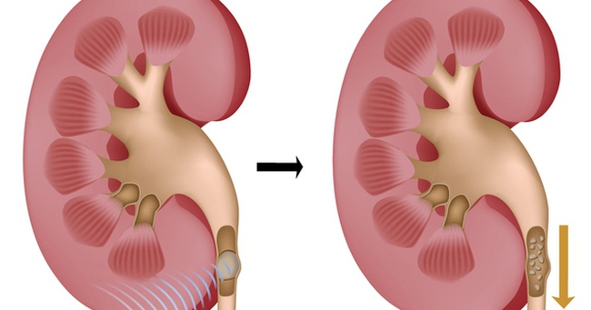 8 câu hỏi thường gặp của người bệnh sỏi tiết niệu