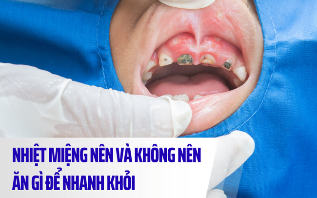 Nhiệt miệng nên ăn gì và kiêng gì để nhanh khỏi?