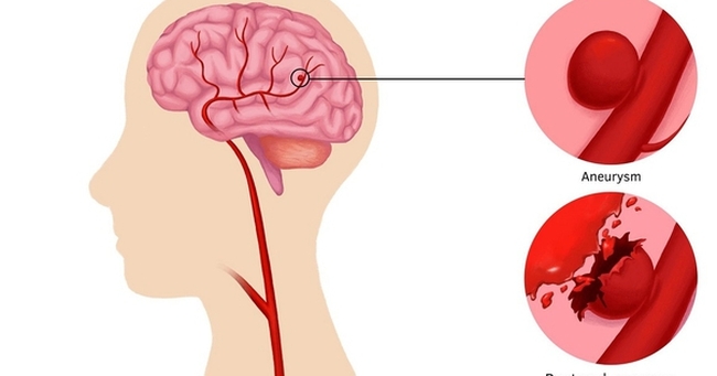 Đau đầu đột ngột coi chừng phình động mạch não