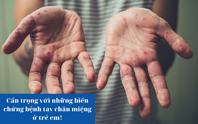 Cẩn trọng với những biến chứng tay chân miệng ở trẻ em!