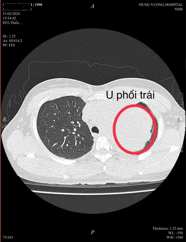 Ung thư phổi ngày càng trẻ hóa