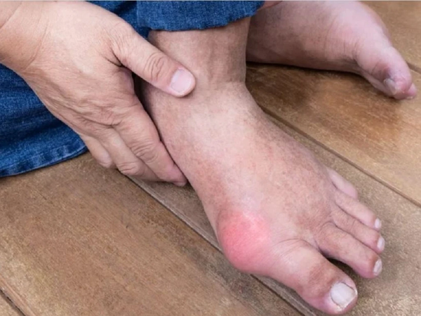 Nguy cơ bệnh gout trở nặng