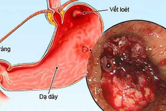 Cảnh giác với viêm loét dạ dày do vi khuẩn HP ở trẻ em