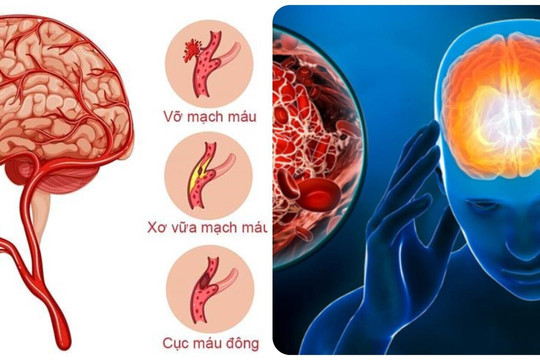 7 dấu hiệu cảnh báo cơn đột quỵ sắp xảy ra