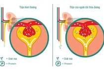 Đường máu cao ảnh hưởng thế nào đến thận?