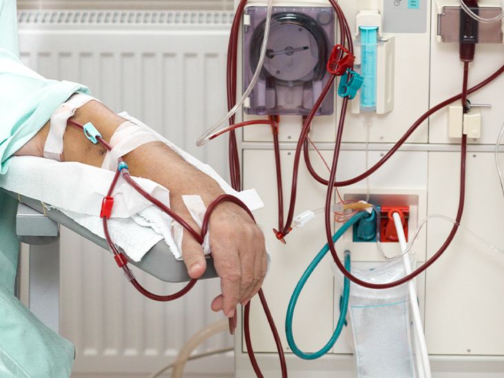 What Is an Arteriovenous (AV) Fistula in Dialysis?