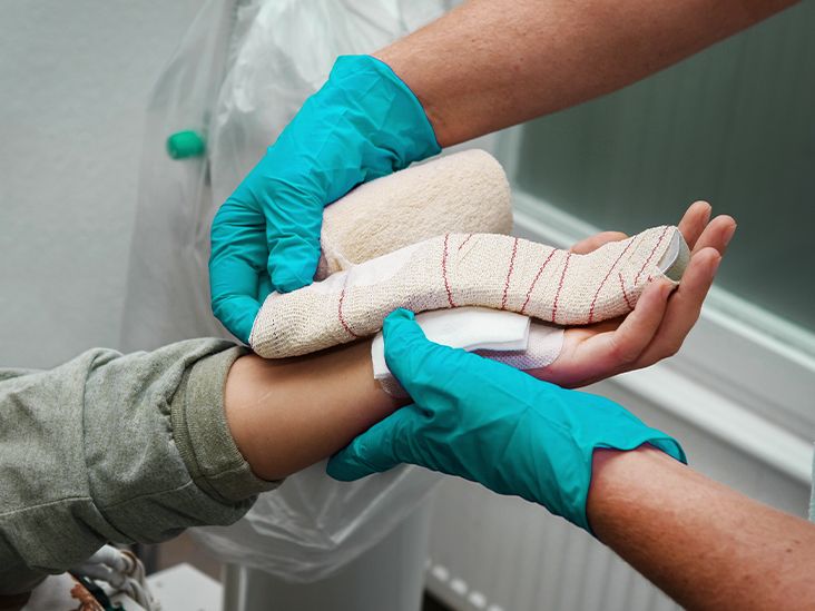 Hội chứng đường hầm Carpal có thể tái phát không?