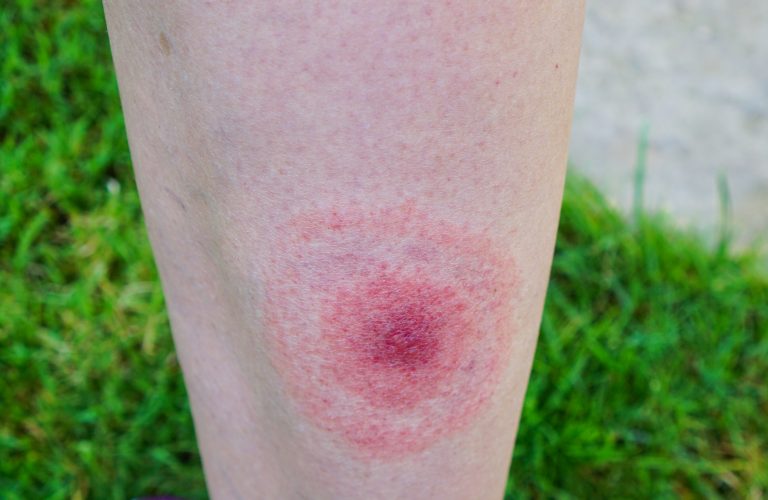 Việc sản xuất gen của bệnh Lyme có thể dẫn đến các phương pháp trị liệu mới