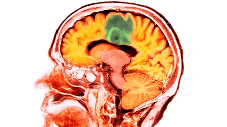 Loại vắc xin mRNA mới cho ung thư não chết người gây ra một phản ứng miễn dịch mạnh mẽ